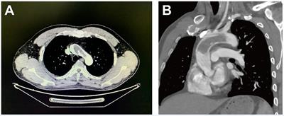 Case report: Surgical strategies of a giant thrombus from the ascending aorta to the arch